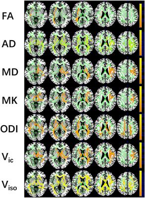 White Matter Abnormalities and Cognitive Deficit After Mild Traumatic Brain Injury: Comparing DTI, DKI, and NODDI